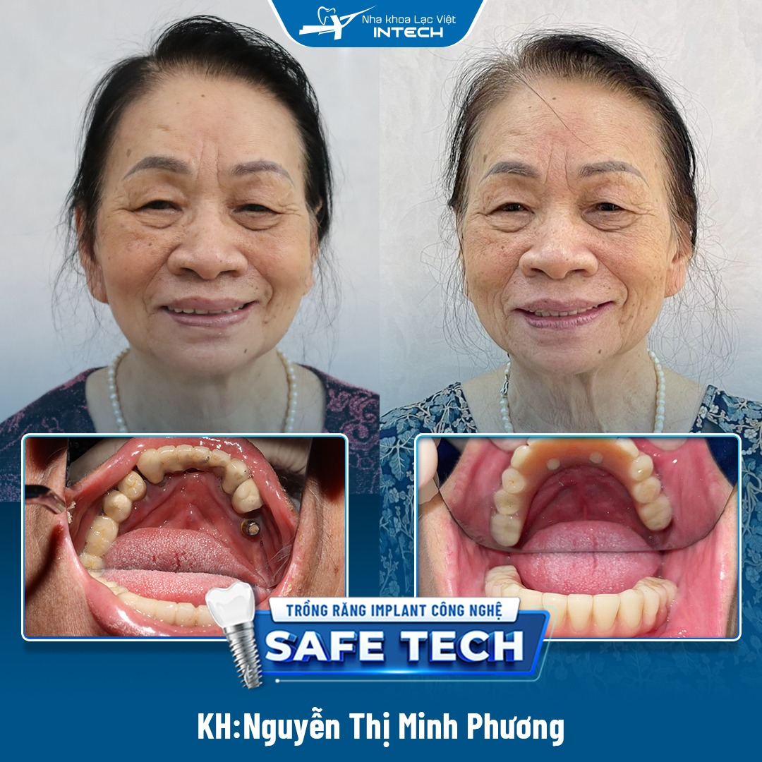 Khách hàng trồng răng implant All - On - 4 toàn hàm dưới tại Nha khoa Lạc Việt Intech