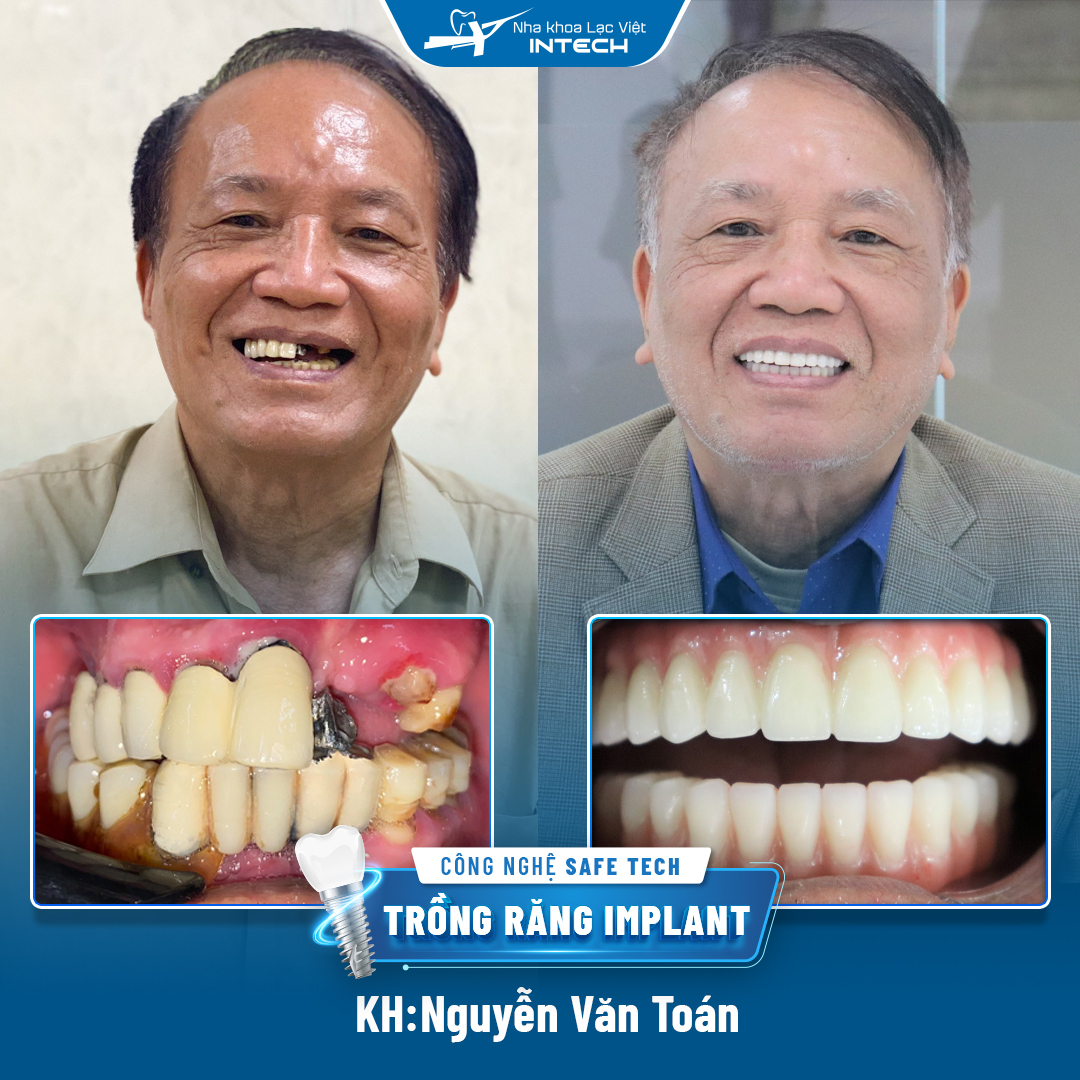 Khách hàng Nguyễn Văn Toán trồng răng Implant All-on-4 toàn 2 hàm