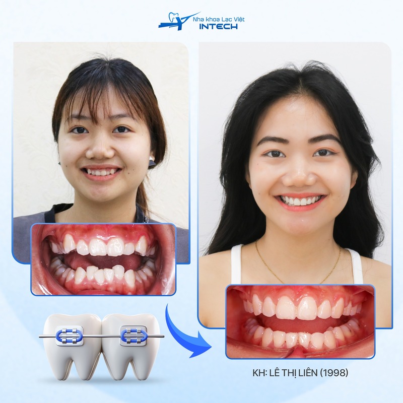 khách hàng niềng răng mắc cài