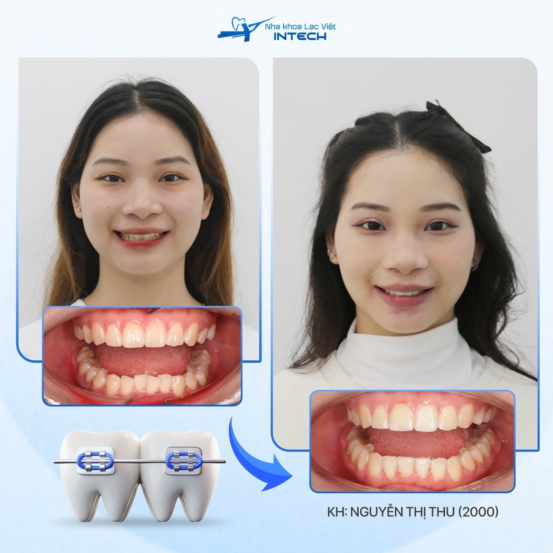 khách hàng niềng răng mắc cài