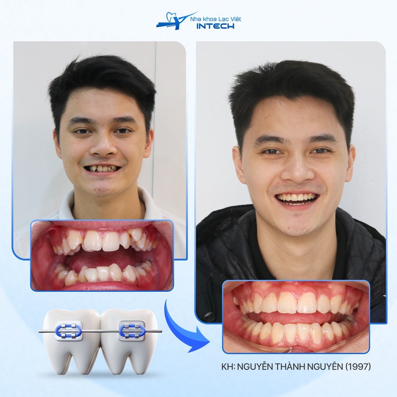 khách hàng niềng răng mắc cài