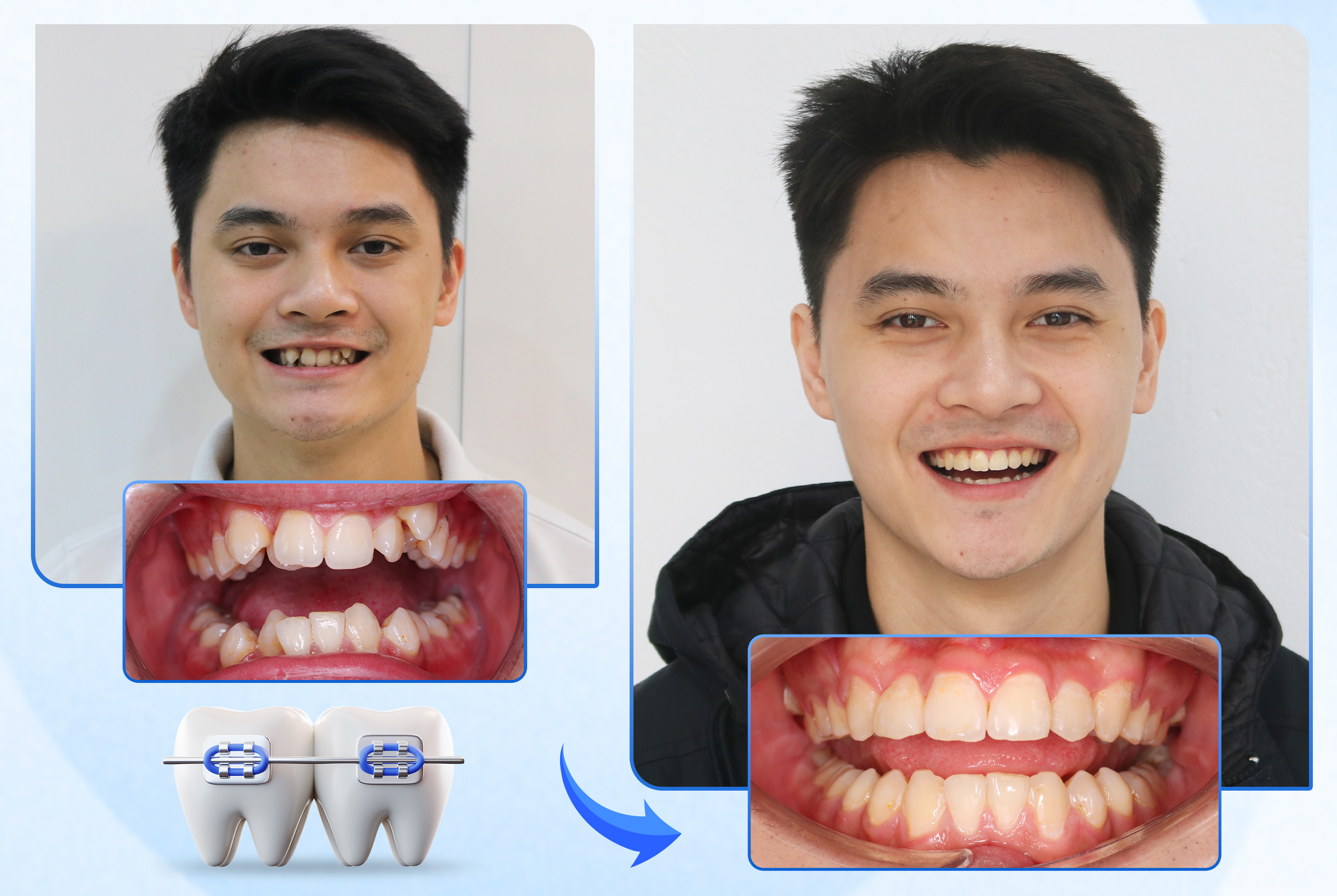 Nha khoa Lạc Việt Intech - Trung tâm trồng răng implant và chỉnh nha chuyên sâu