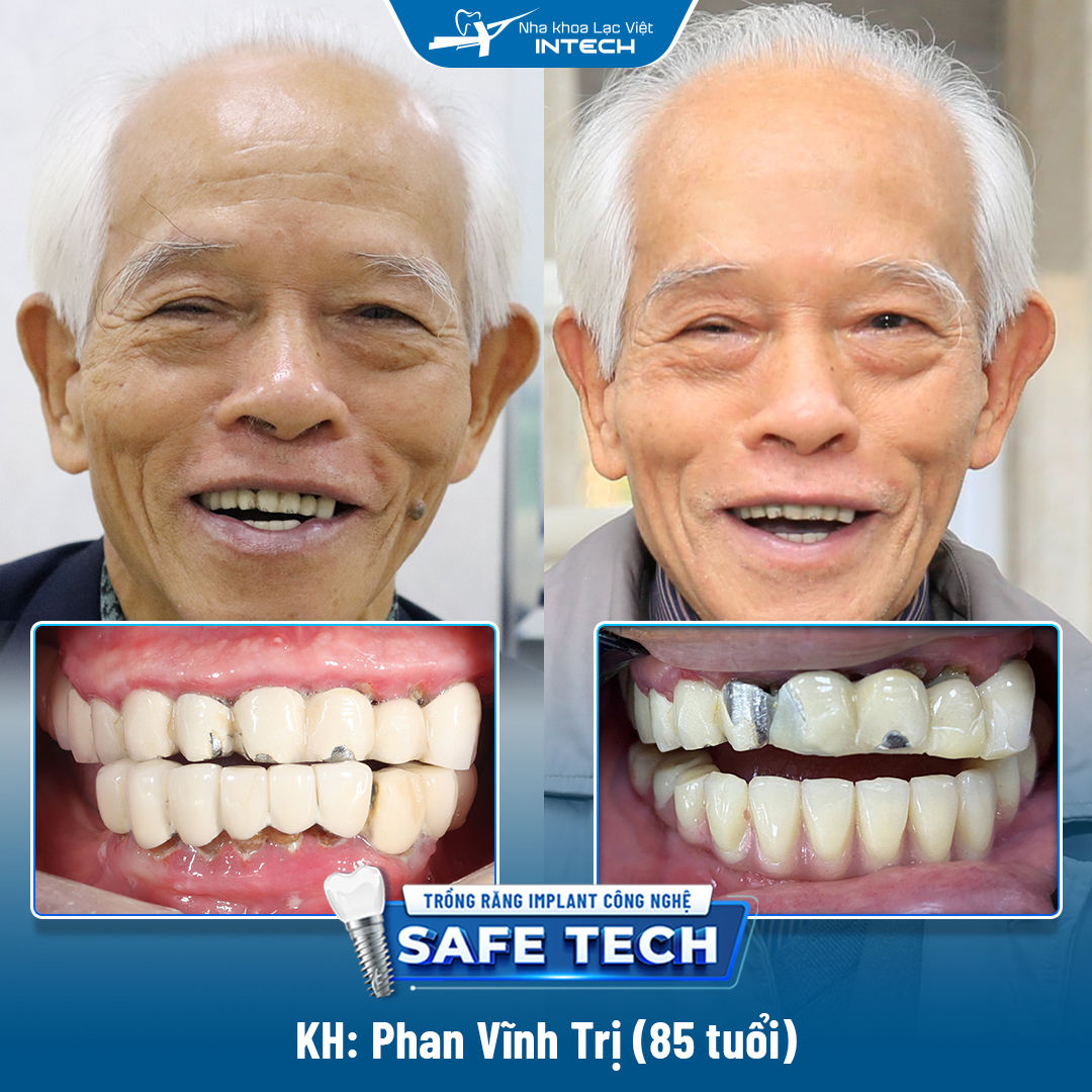 Cụ Phan Vĩnh Trị (85 tuổi) trồng răng Implant All On 6 hàm dưới