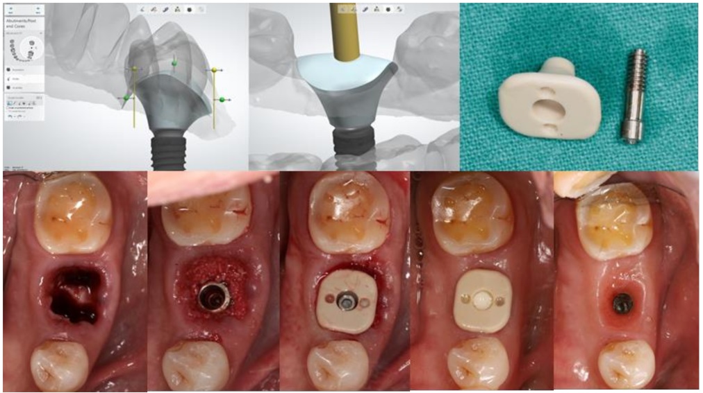 Khách hàng sẽ được đặt trụ lành thương sau khi hoàn tất việc đặt trụ Implant