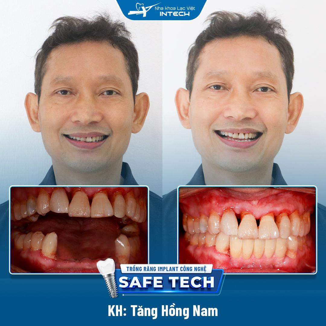 Khách hàng Tăng Hồng Nam cấy ghép Implant răng cửa hàm dưới