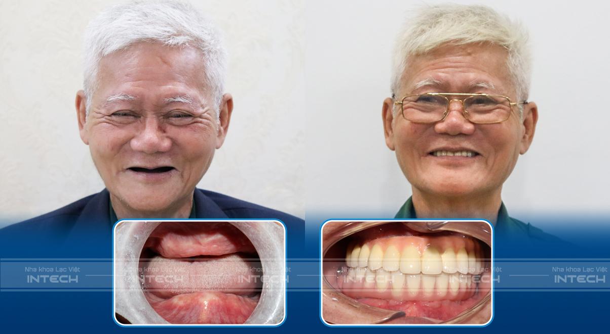 Khách hàng mất răng toàn hàm bằng trồng răng implant All - On - 4 tại Lạc Việt Intech