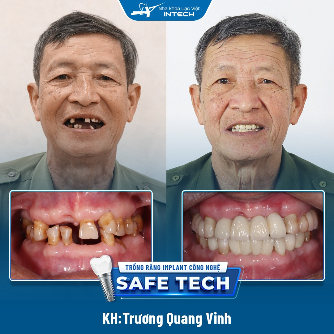 Khách hàng Trương Quang Vinh mất nhiều răng cửa hàm trên và hàm dưới, phục hình bằng phương pháp trồng răng bắc cầu