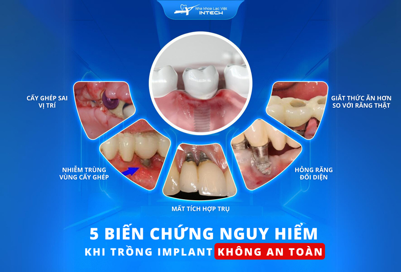 Khi cấy ghép Implant ở cơ sở không đảm bảo an toàn, cô chú/anh chị có thể mắc phải nhiều biến chứng nguy hiểm