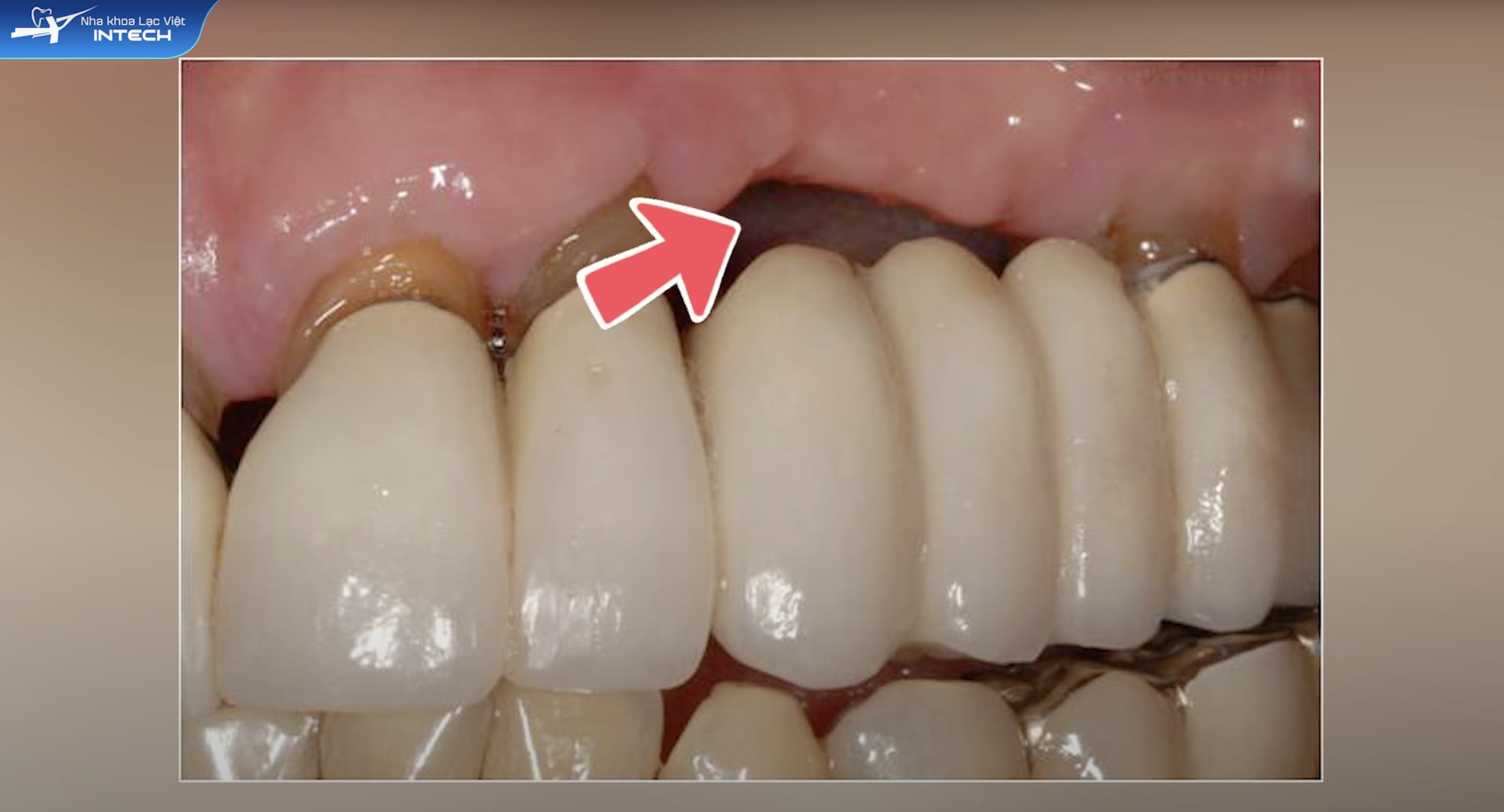 Tiêu xương hàm khó tránh khỏi khi làm cầu răng sứ.