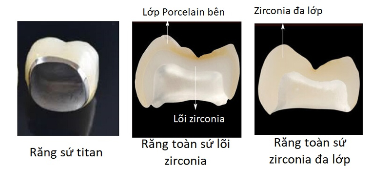 Cô chú/anh chị sẽ không cần tháo mão răng sứ khi chụp cộng hưởng từ MRI nếu sử dụng mão răng làm từ các vật liệu thuận từ như Titanium thuần chất, Zirconia,...