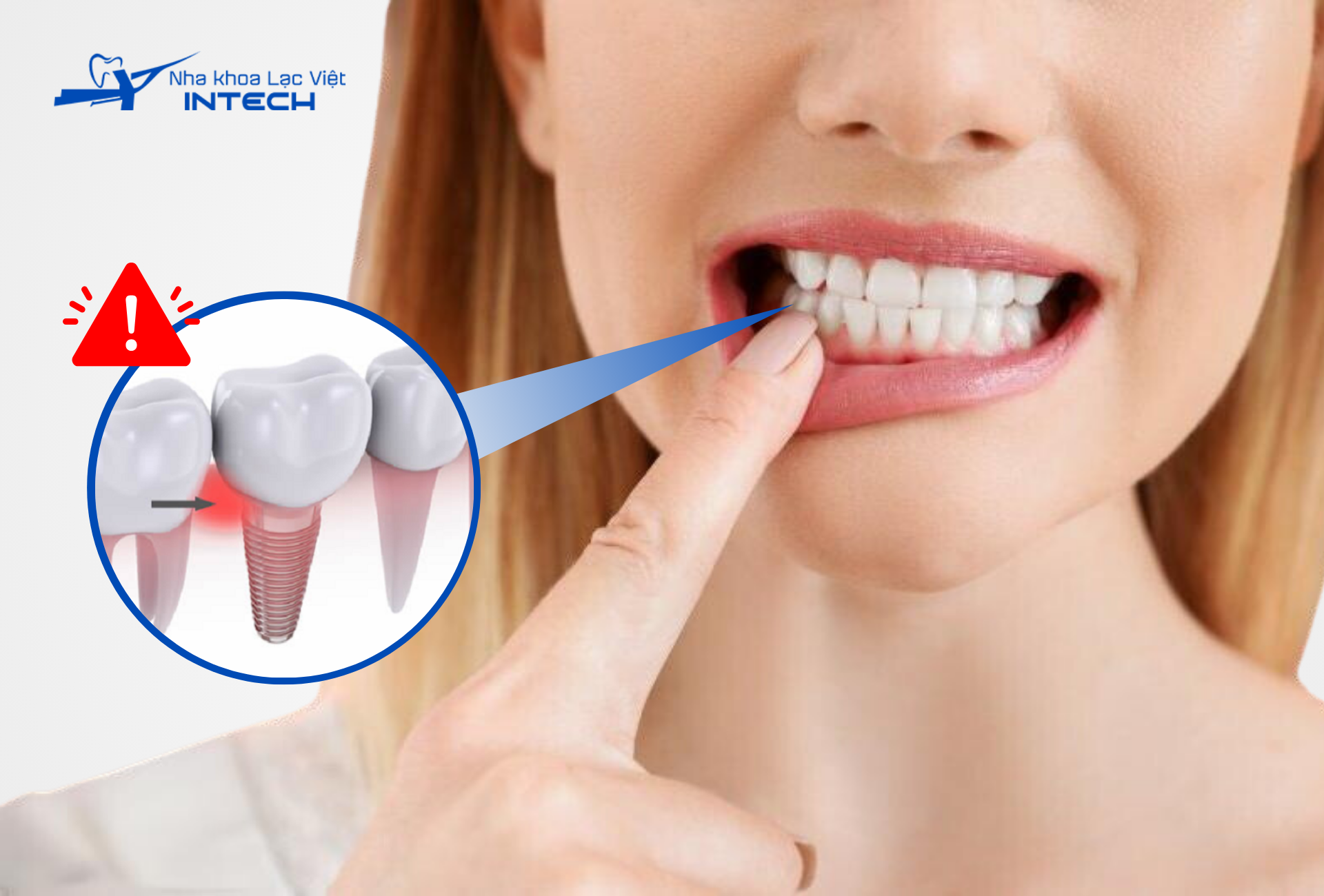 Cô chú/anh chị lưu ý không chạm vào răng Implant vừa cấy ghép trong thời gian đầu để tránh nhiễm trùng xung quanh trụ