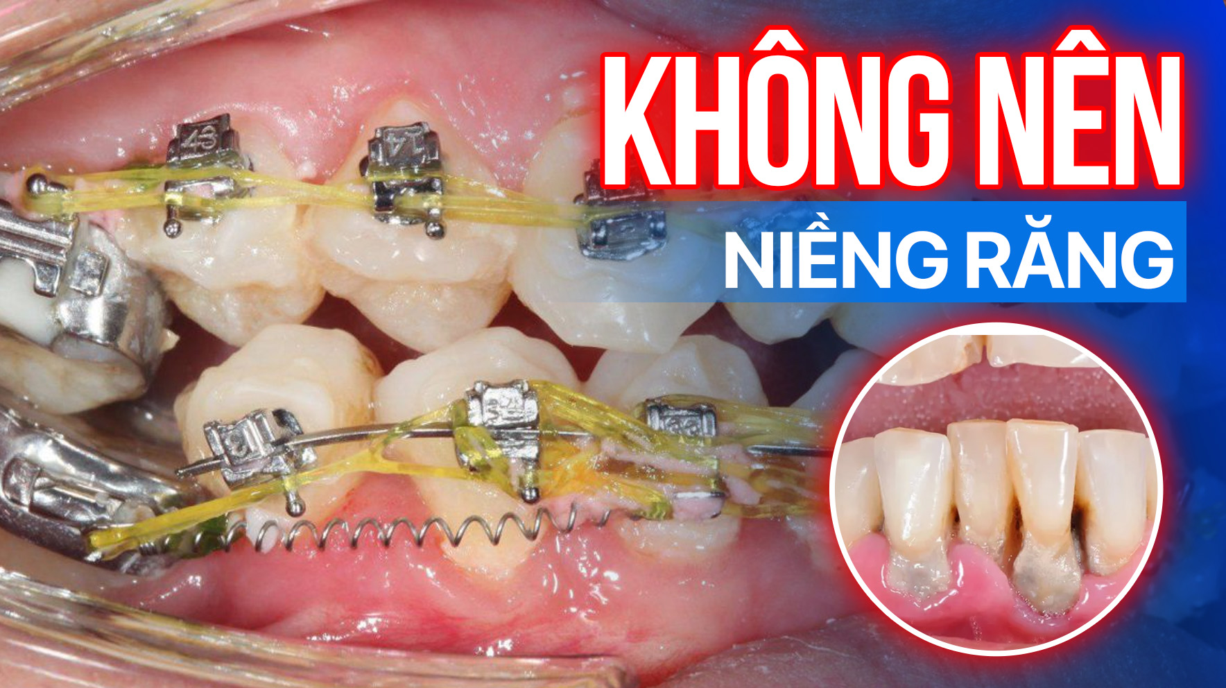 Dán sứ veneer có mấy loại? Loại nào tốt nhất? Loại nào rẻ nhất mà vẫn đảm bảo chất lượng?