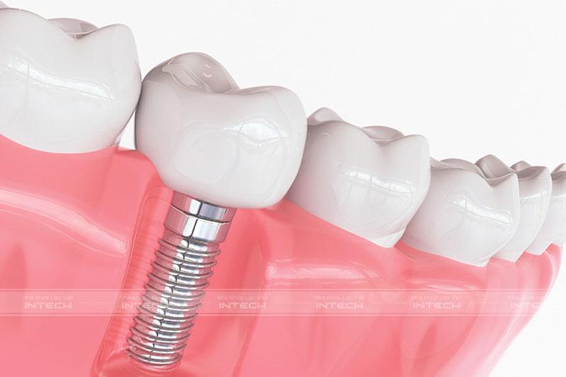 Phương pháp trồng răng Implant 