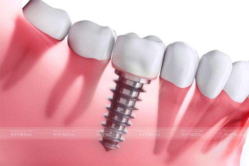 Kỹ thuật trồng răng Implant đòi hỏi vô khuẩn tuyệt đối