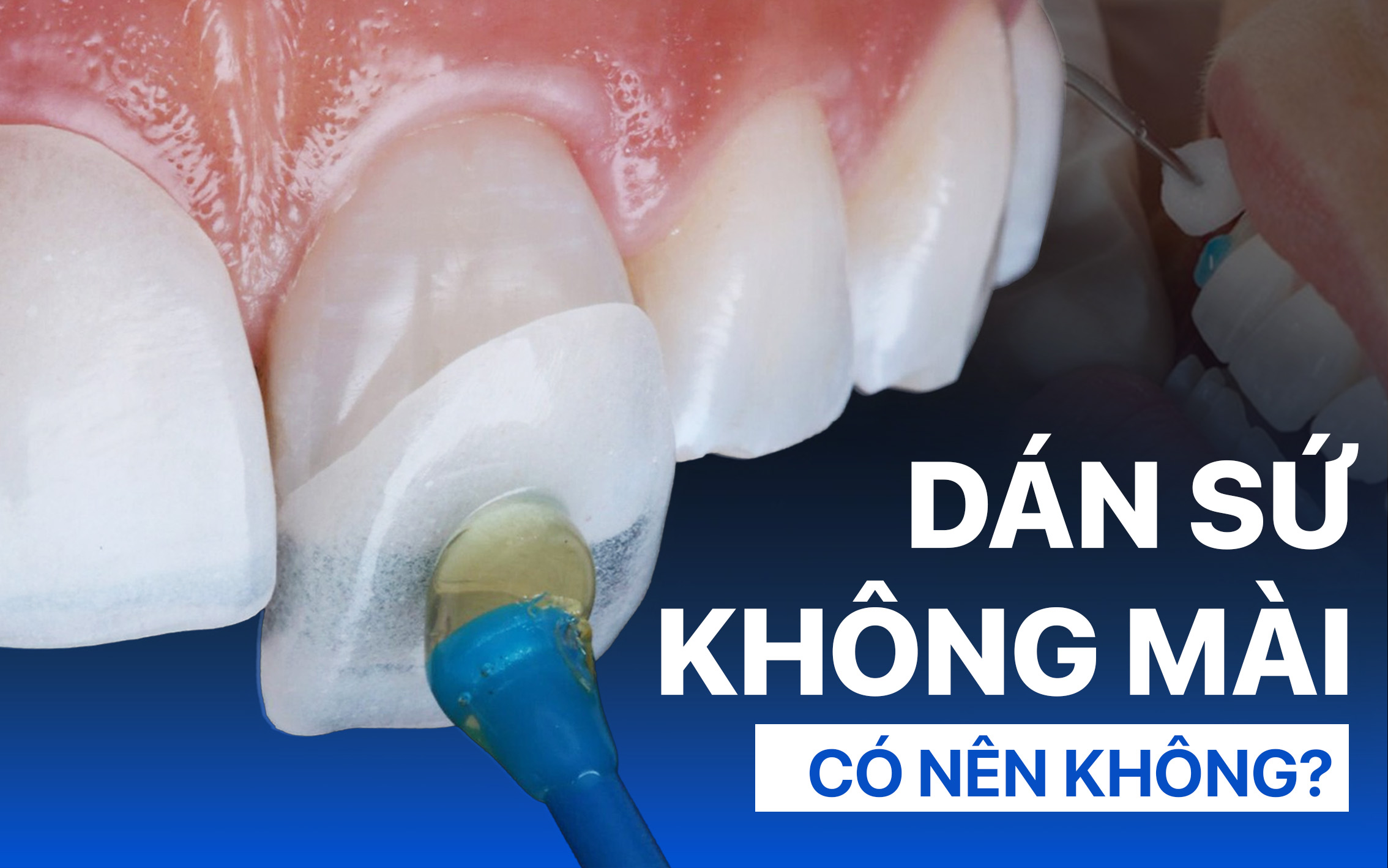 Dán Răng Sứ Không Mài Là Gì: Bác sĩ chia sẻ Ưu và Nhược Điểm