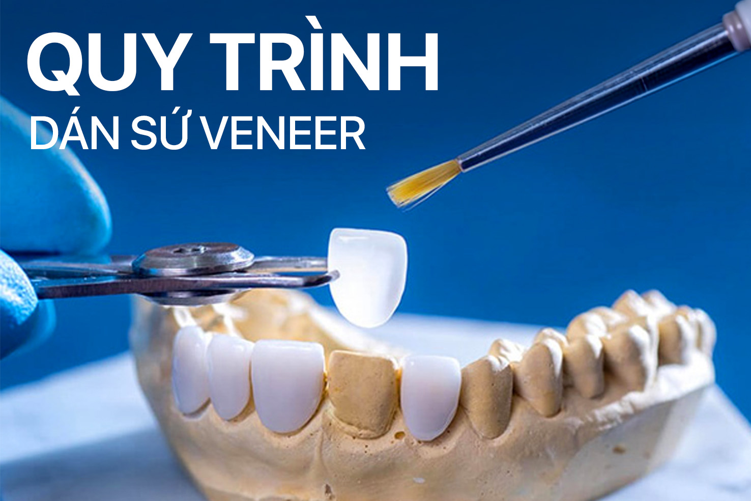 Quy trình dán sứ veneer mất bao lâu? 7 bước chuẩn gồm những gì?