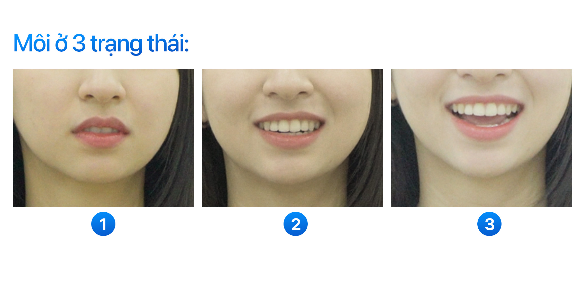 tiêu chuẩn dán sứ đẹp đánh giá theo đường cười