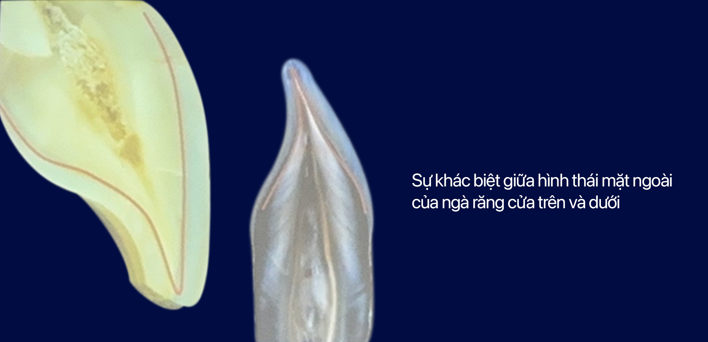 răng sứ không mài