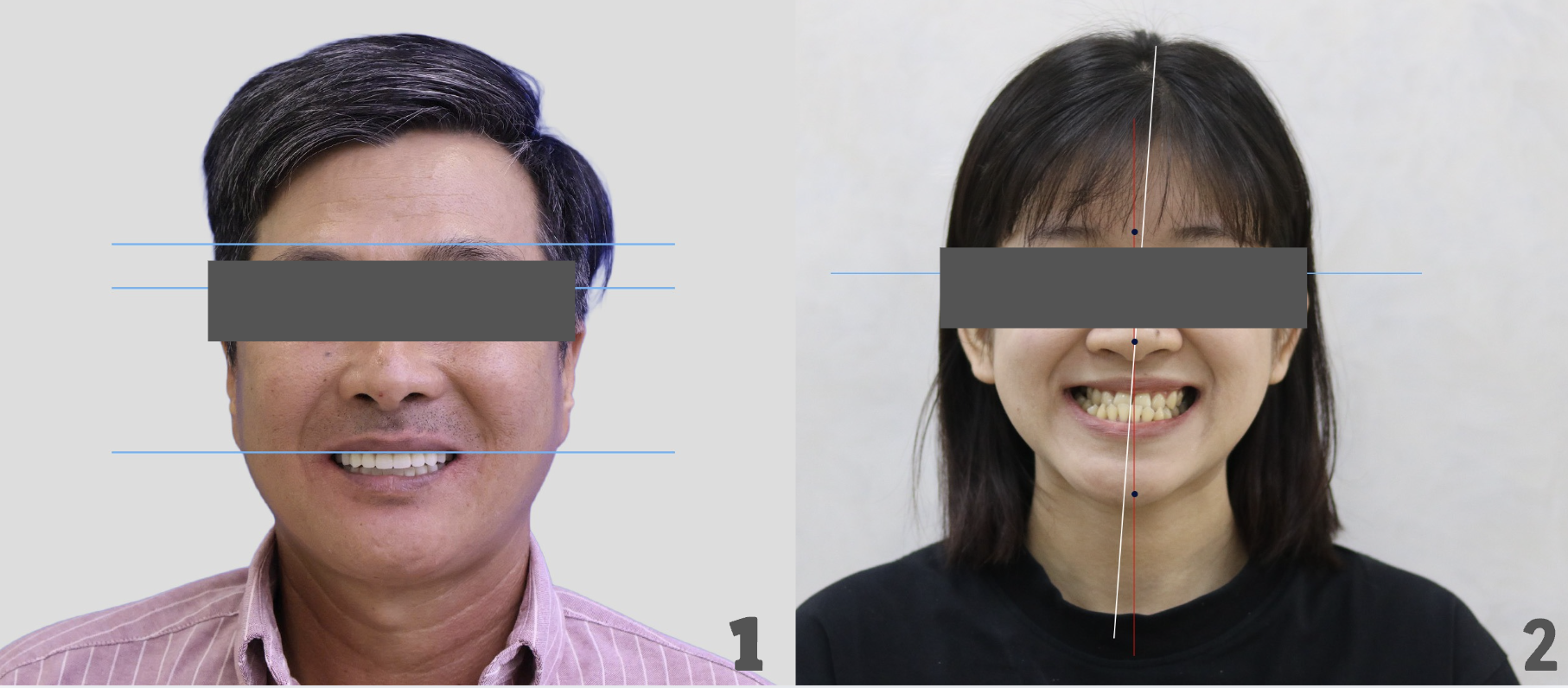 tiêu chuẩn dán veneer theo đường hướng dẫn dọc và và đường hướng dẫn ngang