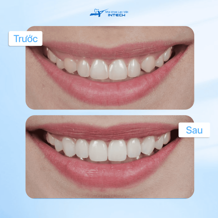 Hình ảnh khách hàng trước và sau khi dán sứ veneer”>
    </div>

    <div class=