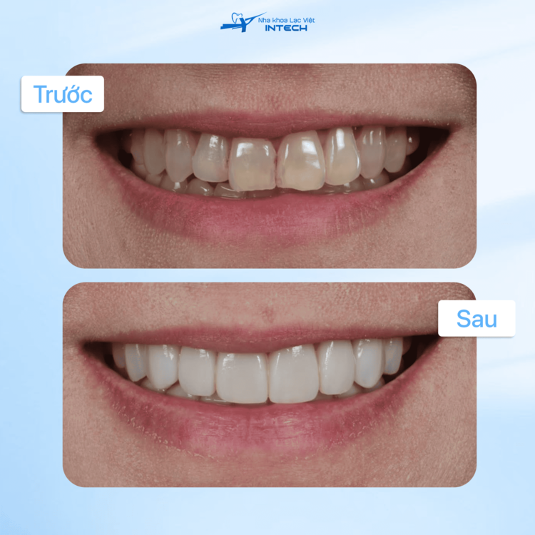 Hình ảnh khách hàng trước và sau khi dán sứ veneer”>    
</div>

    <div class=