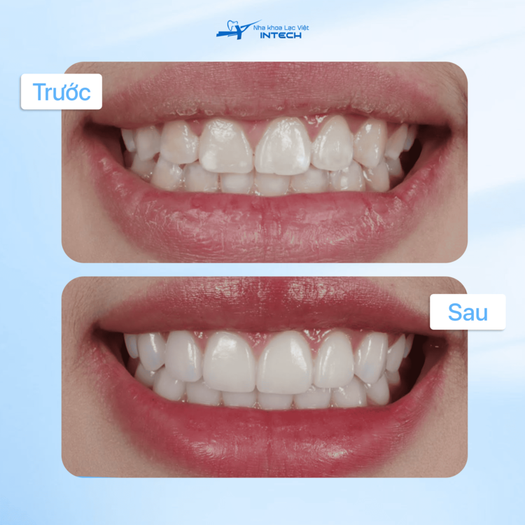 Hình ảnh khách hàng trước và sau khi dán sứ veneer”>
    </div>

    <div class=