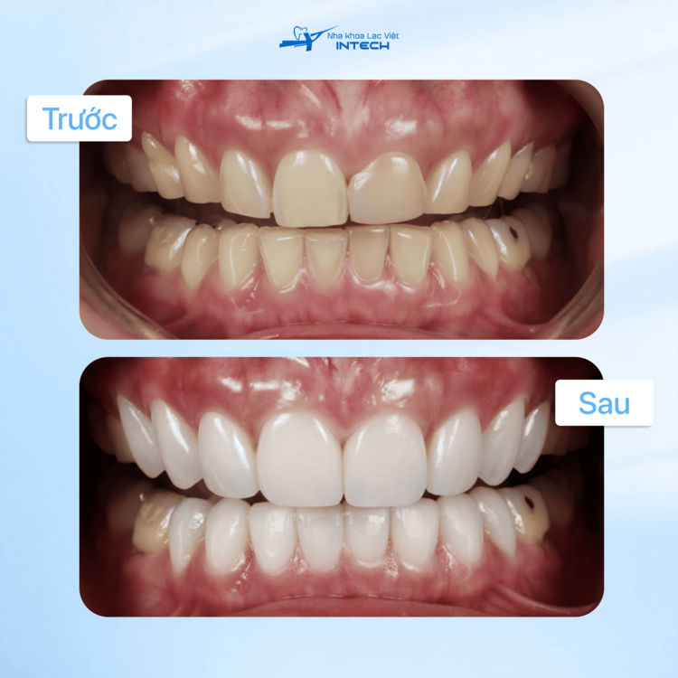 Hình ảnh khách” hàng trước và sau khi dán sứ toàn hàm>
    </div>

  </div>

  <div class=