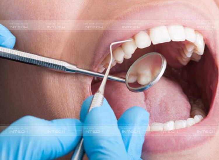 Lấy cao răng để loại bỏ viêm lợi