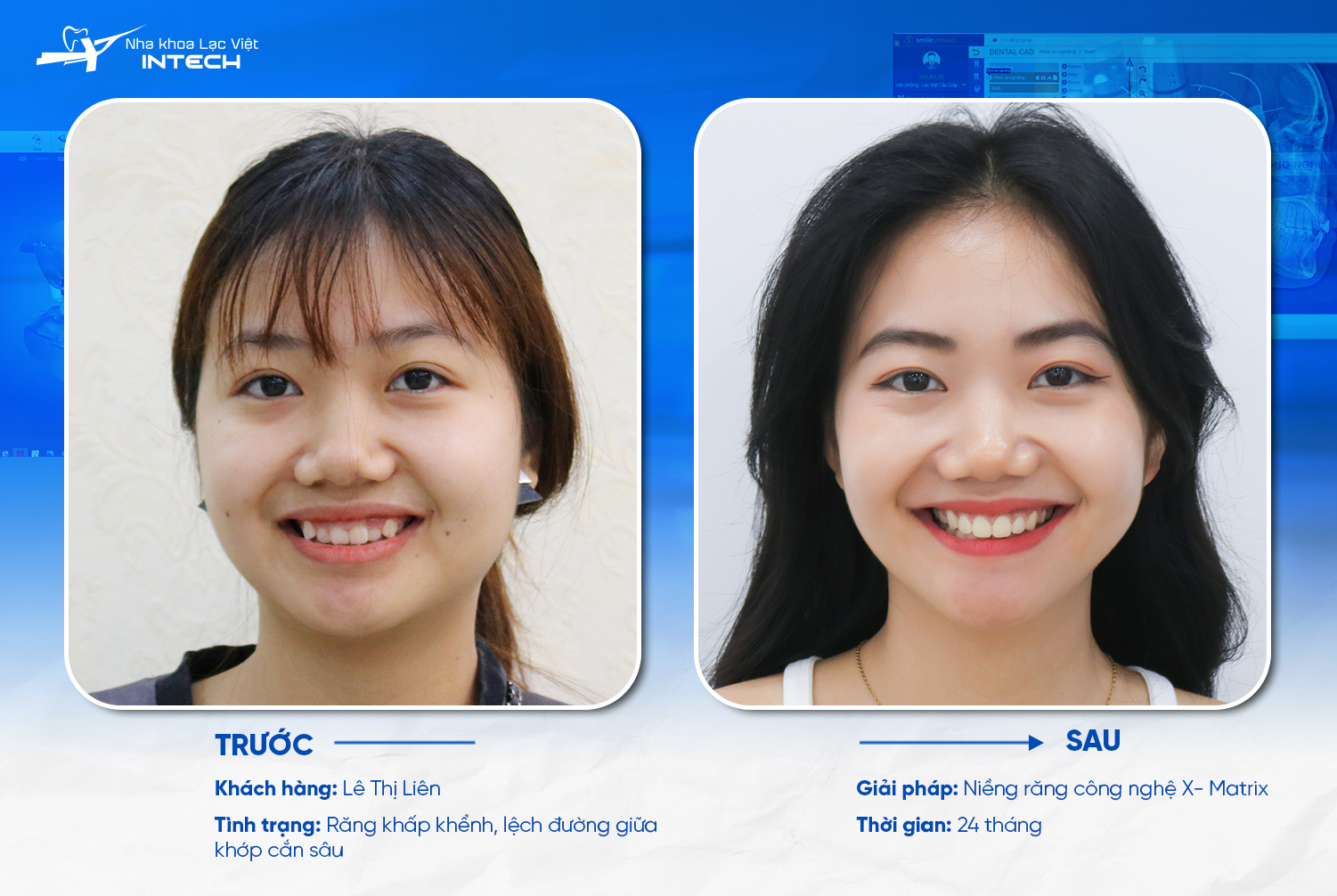 Sự thay đổi sau niềng ẳng 