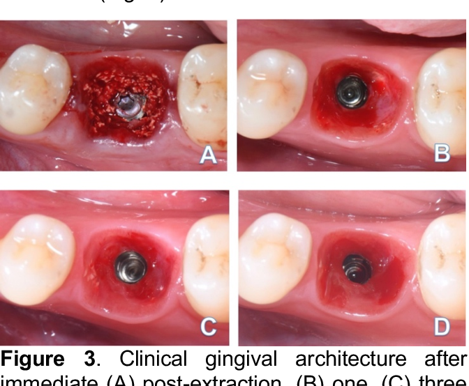 trụ phục hình giải phẫu cá nhân hóa