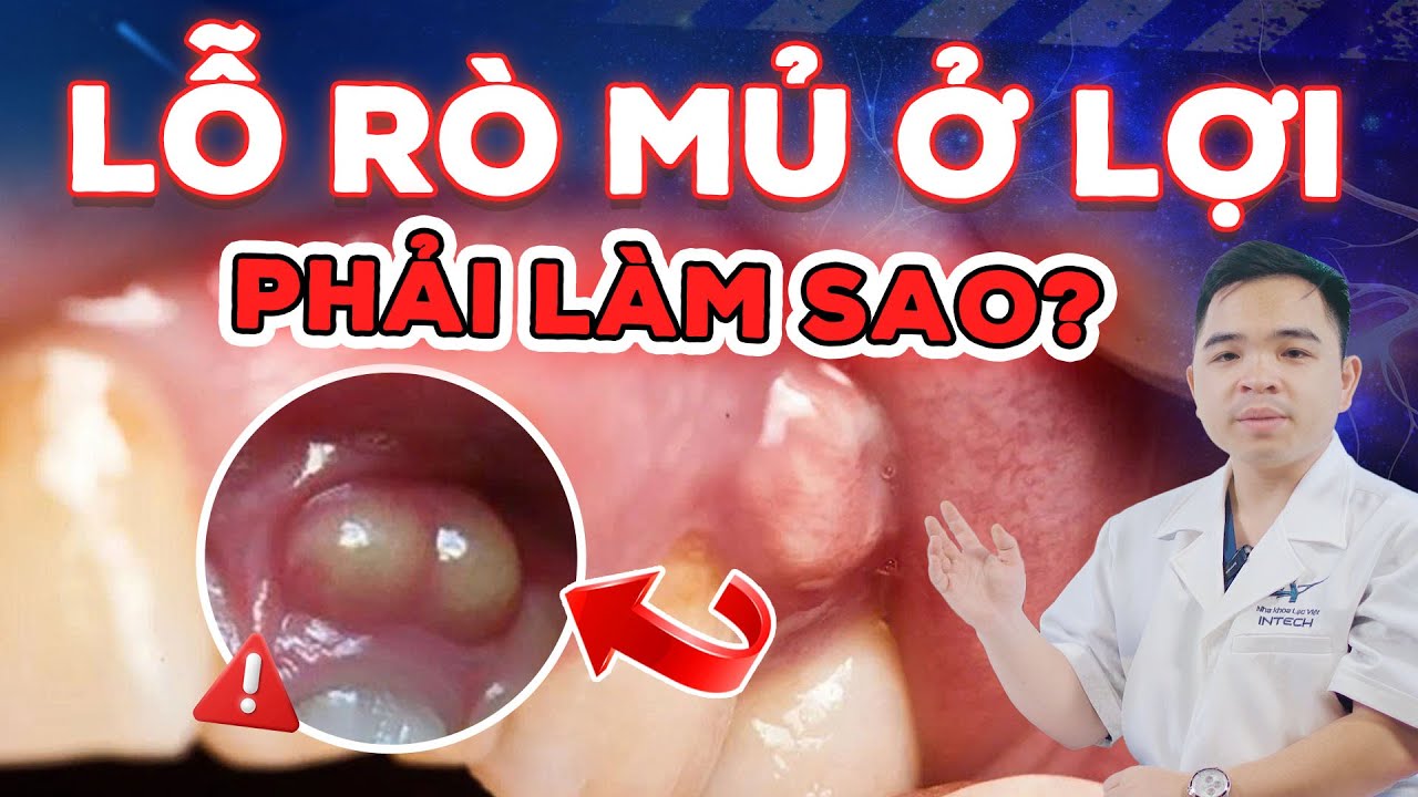 Lỗ Rò Mủ Ở Lợi: Nguyên Nhân, Nguy Cơ Tiêu Xương, Rụng Răng Và Cách Điều Trị Hiệu Quả
