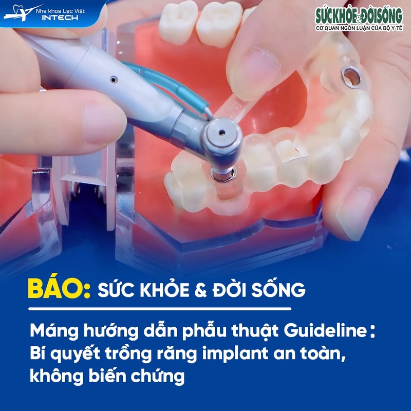 Máng hướng dẫn phẫu thuật Guideline hỗ trợ bác sĩ đặt trụ Implant đúng phương và hướng truyền lực, đảm bảo khả năng ăn nhai của răng Implant