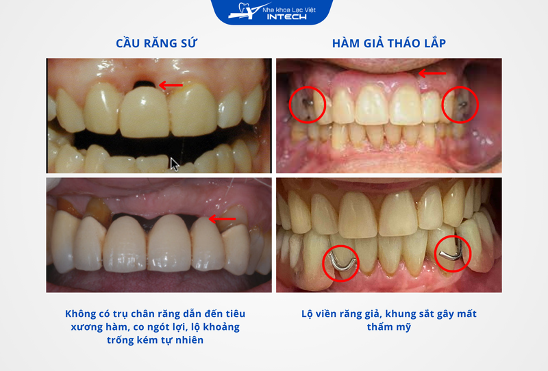 Phương pháp cầu răng sứ và hàm giả tháo lắp không thay thế chân răng mất, dẫn đến nhiều biến chứng và làm giảm thẩm mỹ răng miệng 