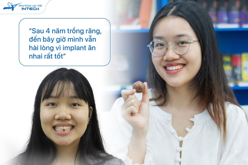 Răng Implant giúp phục hồi chức năng nhai hoàn hảo nhờ trụ Titanium cố định vào xương hàm, mang lại cảm giác tự nhiên và bảo vệ răng thật