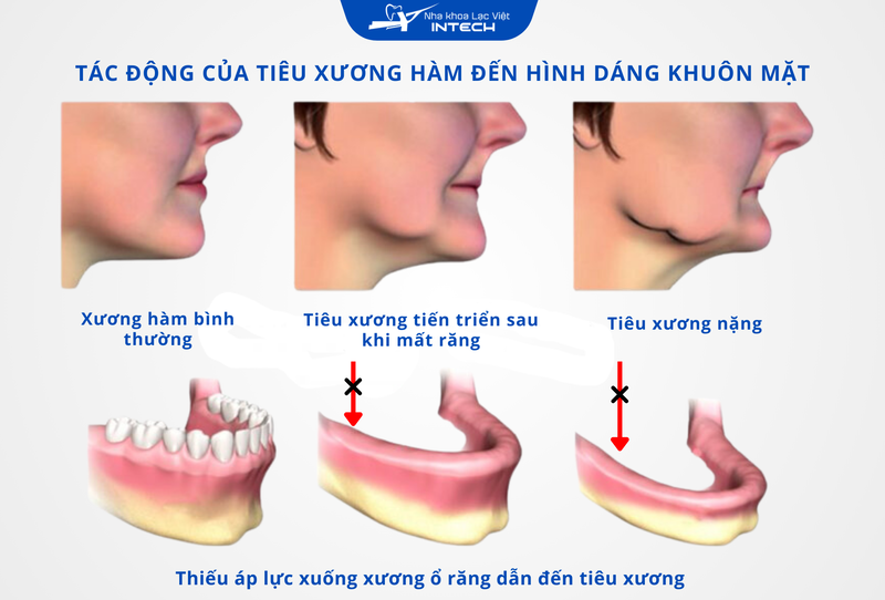 Tiêu xương hàm gây ra các biến dạng khuôn mặt như chảy xệ, lép môi má, già nua trước tuổi