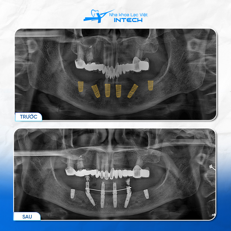 Trụ Implant được cấy trực tiếp vào xương hàm, tạo thành một khối vững chắc giúp phân tán lực nhai, khôi phục khả năng ăn nhai tự nhiên