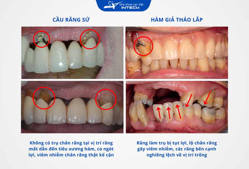 Về lâu dài, vùng mất răng sẽ bị tiêu xương hàm, dẫn đến co ngót lợi, nghiêng lệch các răng kế cận, gây ra các biến chứng răng miệng nghiêm trọng