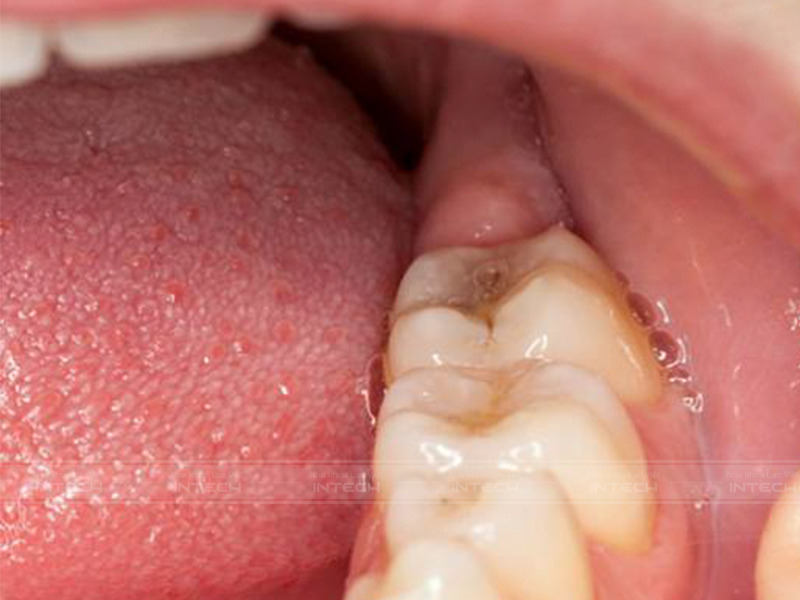 Phần lợi trùm tại vị trí răng khôn sẽ dễ bị viêm nhiễm do nằm ở vị trí dễ giắt thức ăn gây tích tụ vi khuẩn