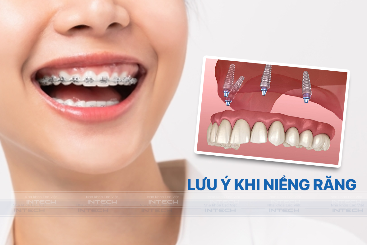 Một số lưu ý bệnh nhân cần ghi nhớ trong quá trình niềng răng