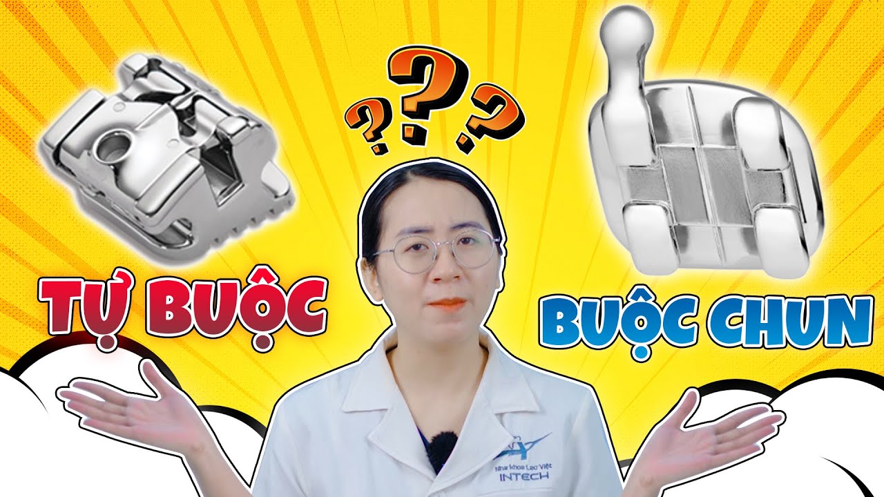 So sánh ưu nhược điểm của mắc cài kim loại tự buộc và mắc cài kim loại thường