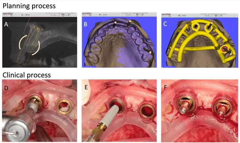 Nha khoa Lạc Việt Intech khẳng định uy tín nhờ công nghệ đặt trụ hiện đại, áp dụng thường quy máng hướng dẫn tăng độ chính xác.