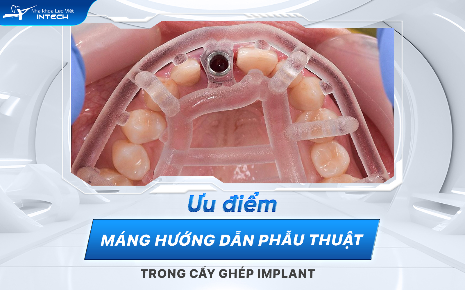 Máng hướng dẫn phẫu thuật Guideline mang nhiều ưu điểm nổi bật, giúp đảm bảo trụ Implant đặt chính xác trong khoang miệng