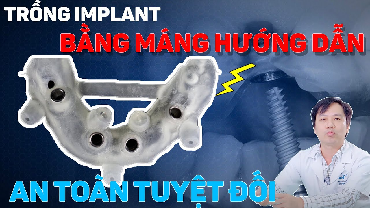 Máng hướng dẫn phẫu thuật Guideline của Nha khoa Lạc Việt Intech giúp quá trình cấy ghép implant diễn ra chính xác, an toàn, nhanh chóng