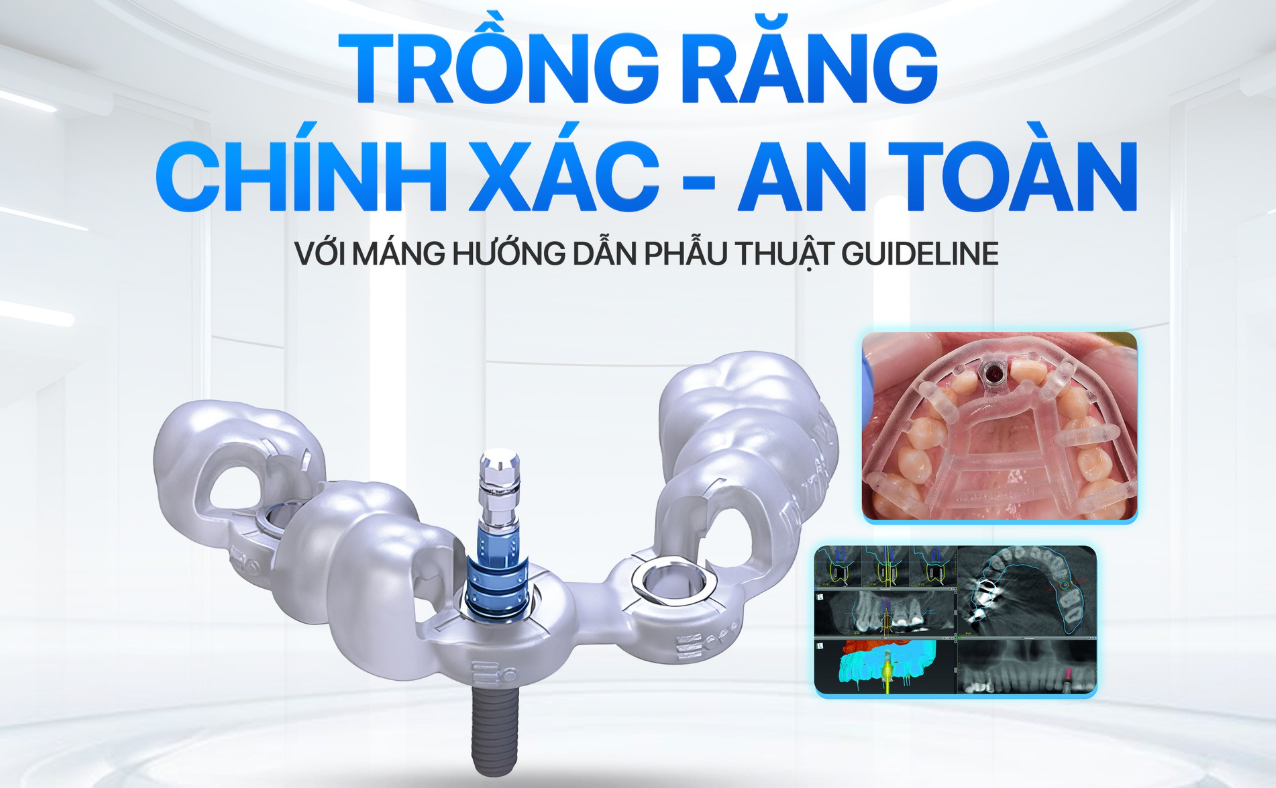 Nha khoa Lạc Việt Intech áp dụng thường quy máng hướng dẫn phẫu thuật vào cấy ghép implant.
