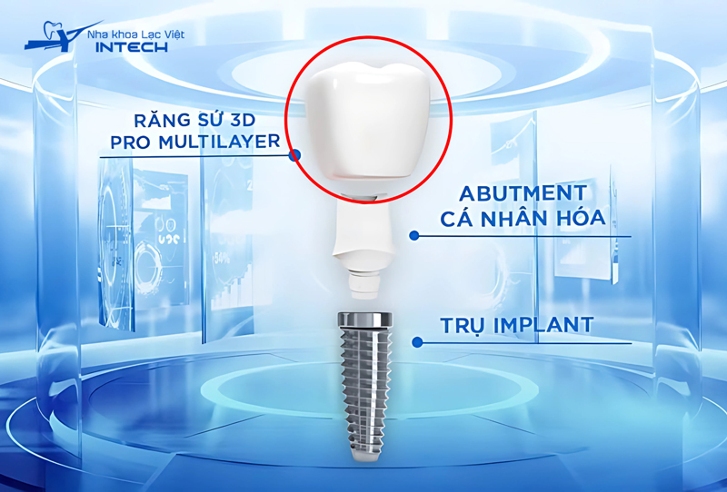 Mão răng sứ bọc bên ngoài trụ phục hình, có vai trò mô phỏng hình dạng, màu sắc và chức năng của răng thật