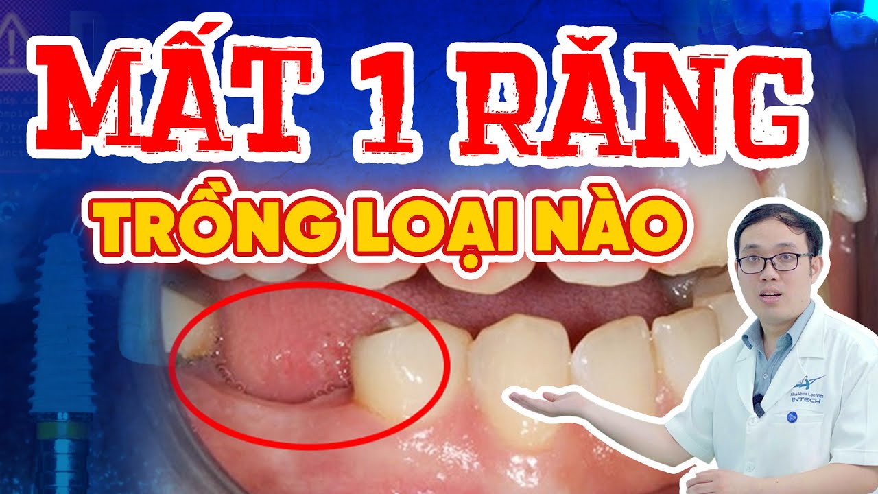 Mất 1 Răng Hàm Có Sao Không? Giải Pháp Hiệu Quả Để Giữ Khớp Cắn Ổn Định