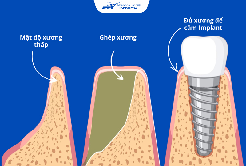 Mật độ xương hàm thấp không đảm bảo tính vững ổn cần thiết cho trụ Implant, bác sĩ có thể chỉ định làm thủ thuật ghép xương