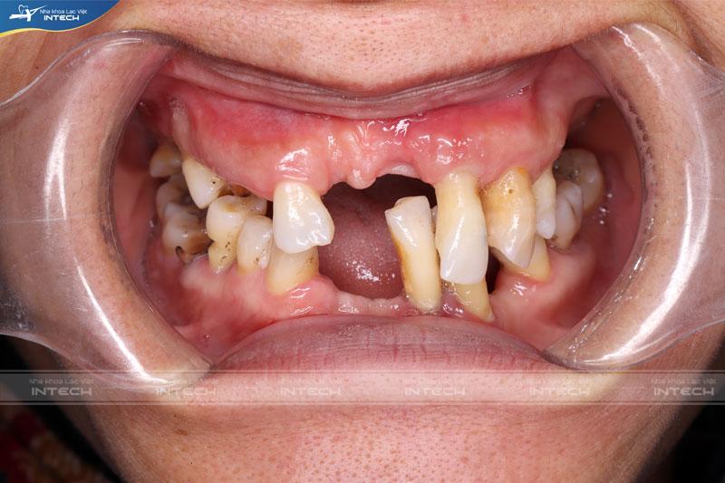 Mất nhiều răng gây tụt nướu, răng lung lay