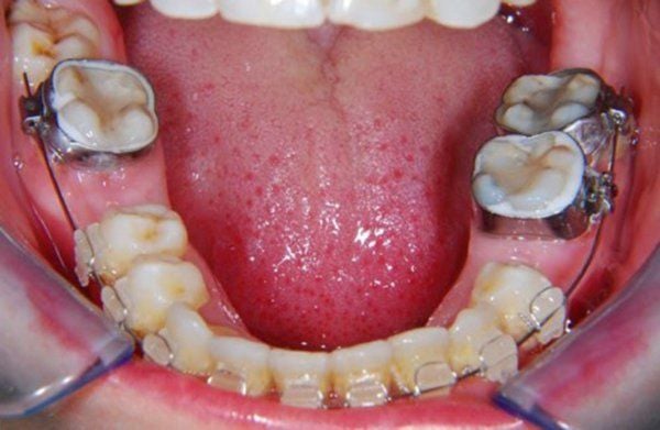 MẤT RĂNG 6 CÓ NIỀNG ĐƯỢC KHÔNG - 3 GIẢI PHÁP AN TOÀN