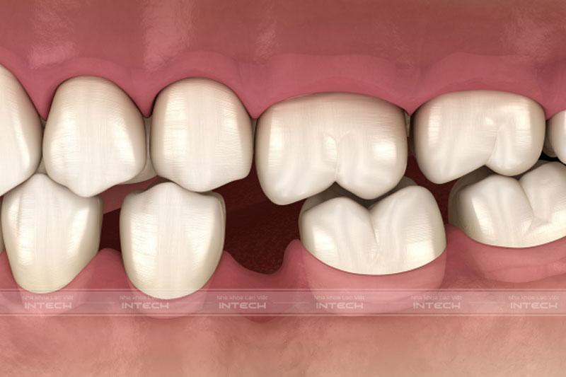 Mất răng lâu ngày dẫn đến tình trạng tiêu xương